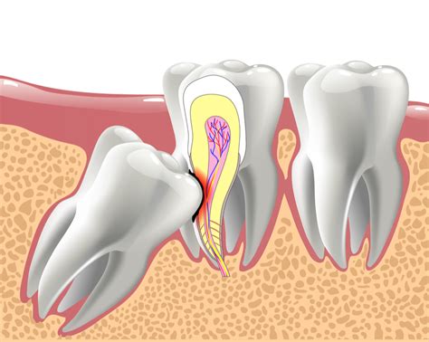 Wisdom Teeth