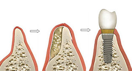 Bone Grafting