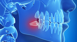 Exposure of Impacted Teeth
