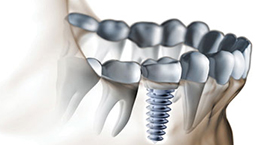 Dental Implants