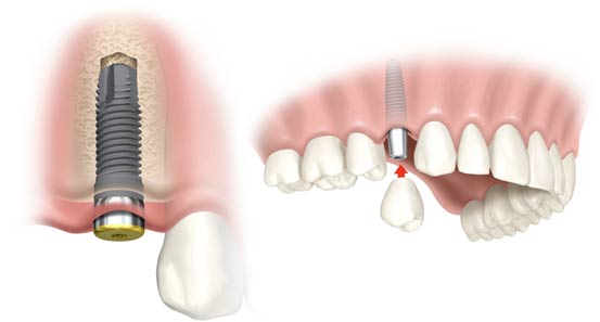 Implants