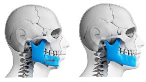 Jaw Advancement