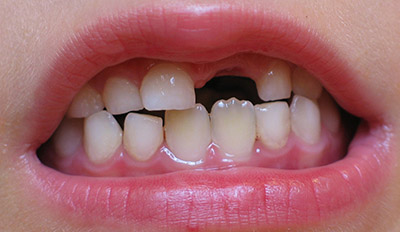 Missing Tooth